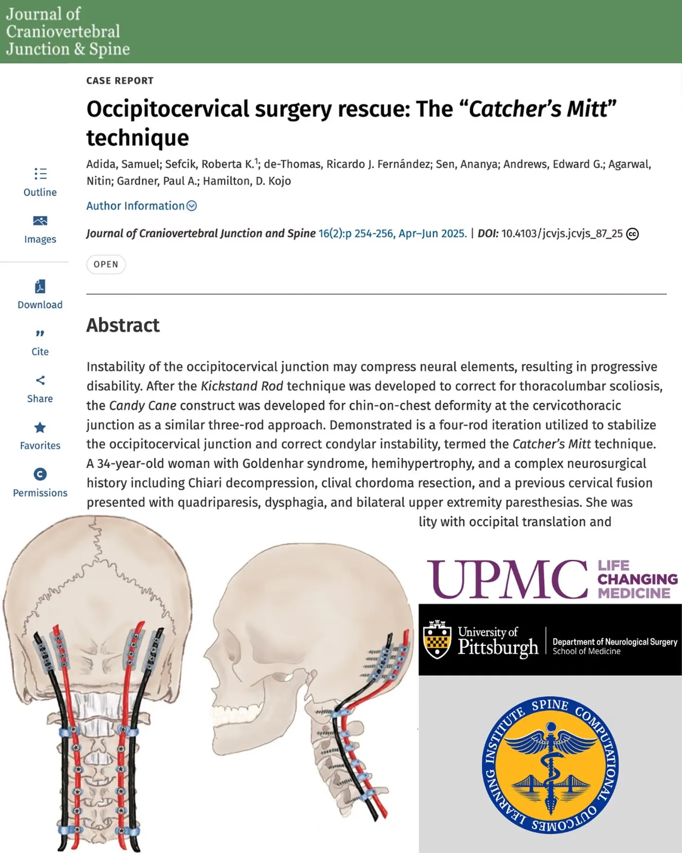 Journal of Craniovertebral Junction and Spine case report on the Catcher's Mitt technique, with illustrations of the four-rod occipitocervical construct