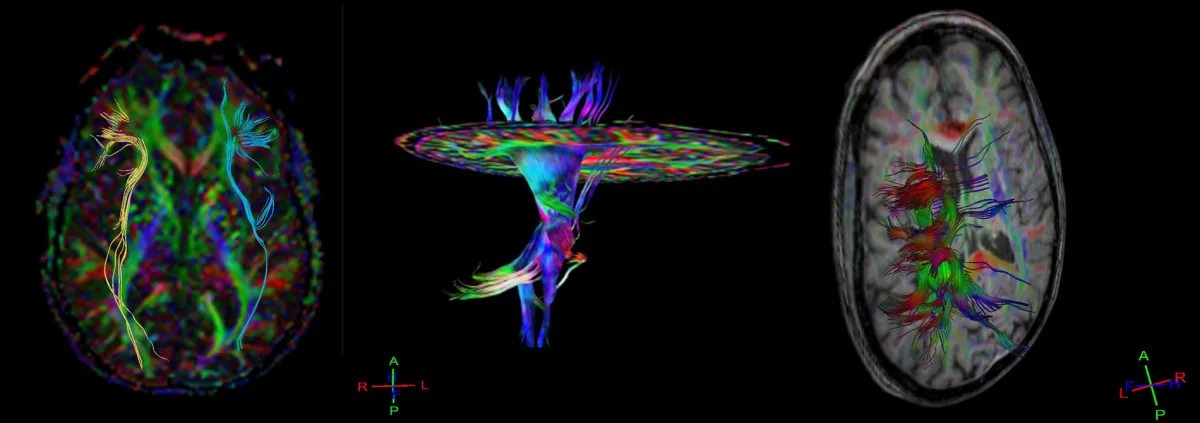 DBSI imaging and axonal injury detection research