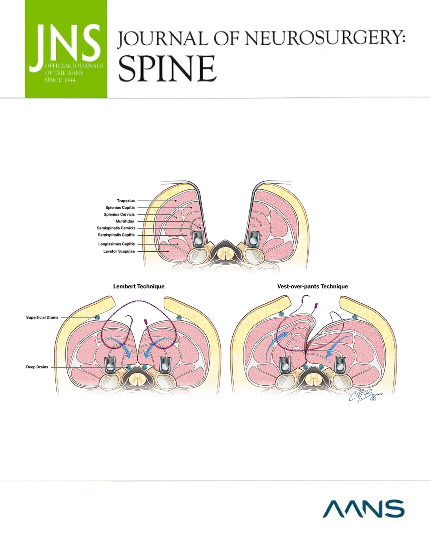 Cover of the Journal of Neurosurgery: Spine showing an illustration of the Lembert and vest-over-pants techniques for paraspinal muscle flap advancement