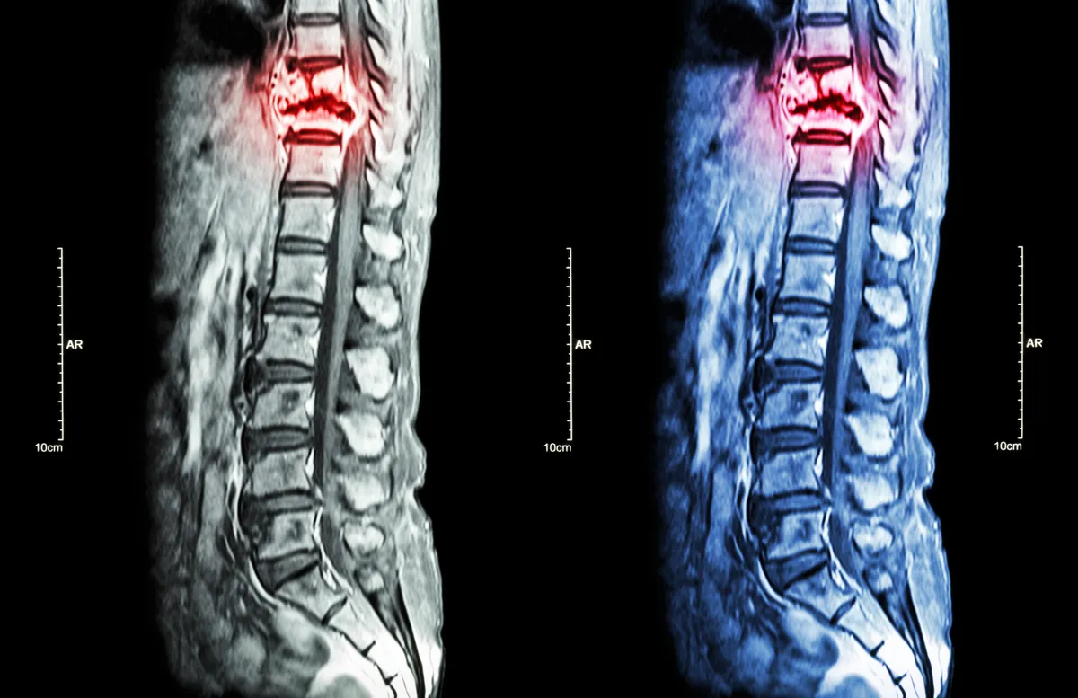 TRACK-SCI spinal cord injury research initiative